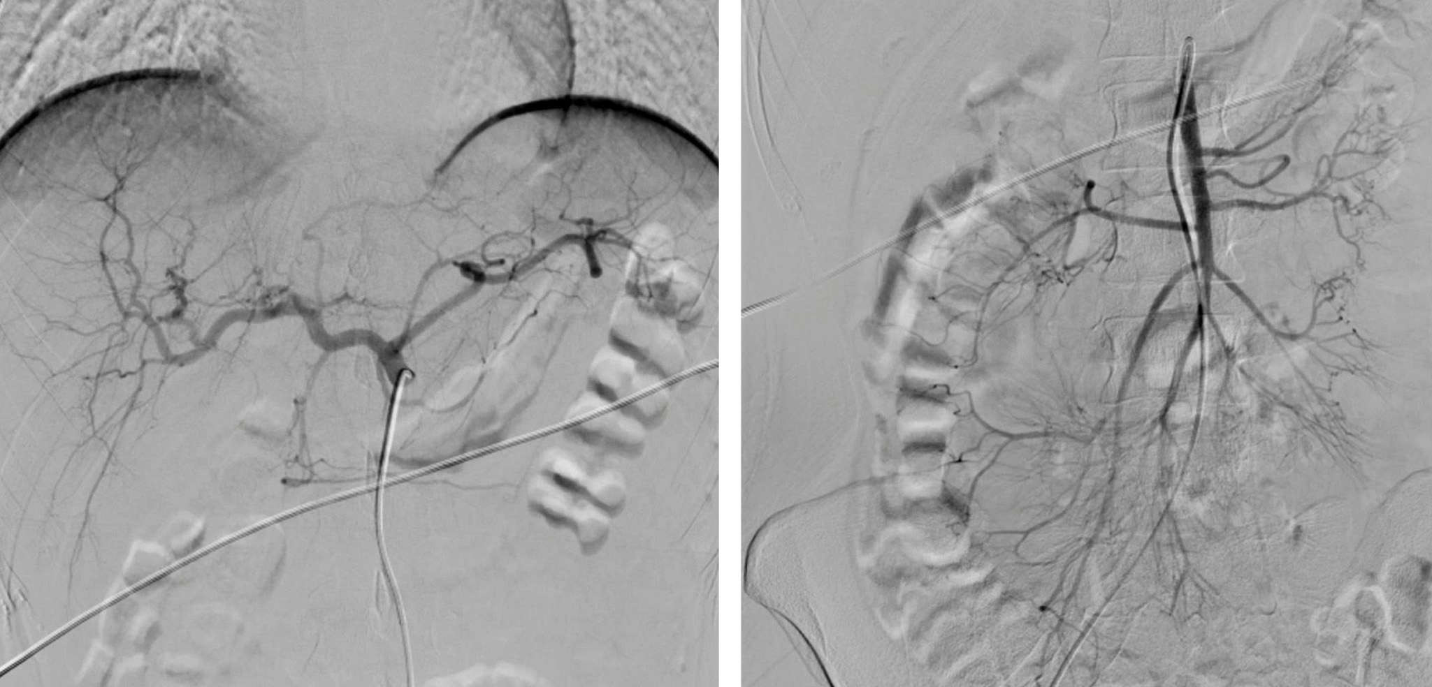 Figure 1. Abdominal aortogram and selective mesenteric vessel study within normal limits for age. Source: Author’s File.