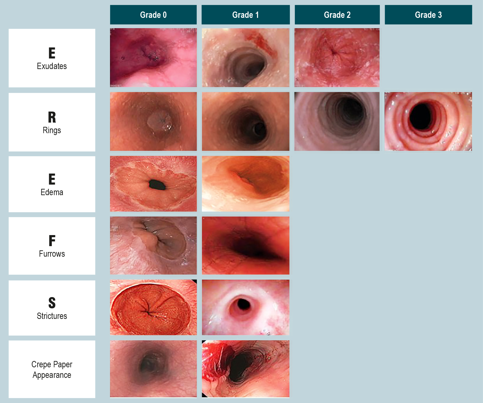 Figure 1. Endoscopic Characteristics of EREFS Scores in the Evaluation of Eosinophilic Esophagitis Author’s own research.