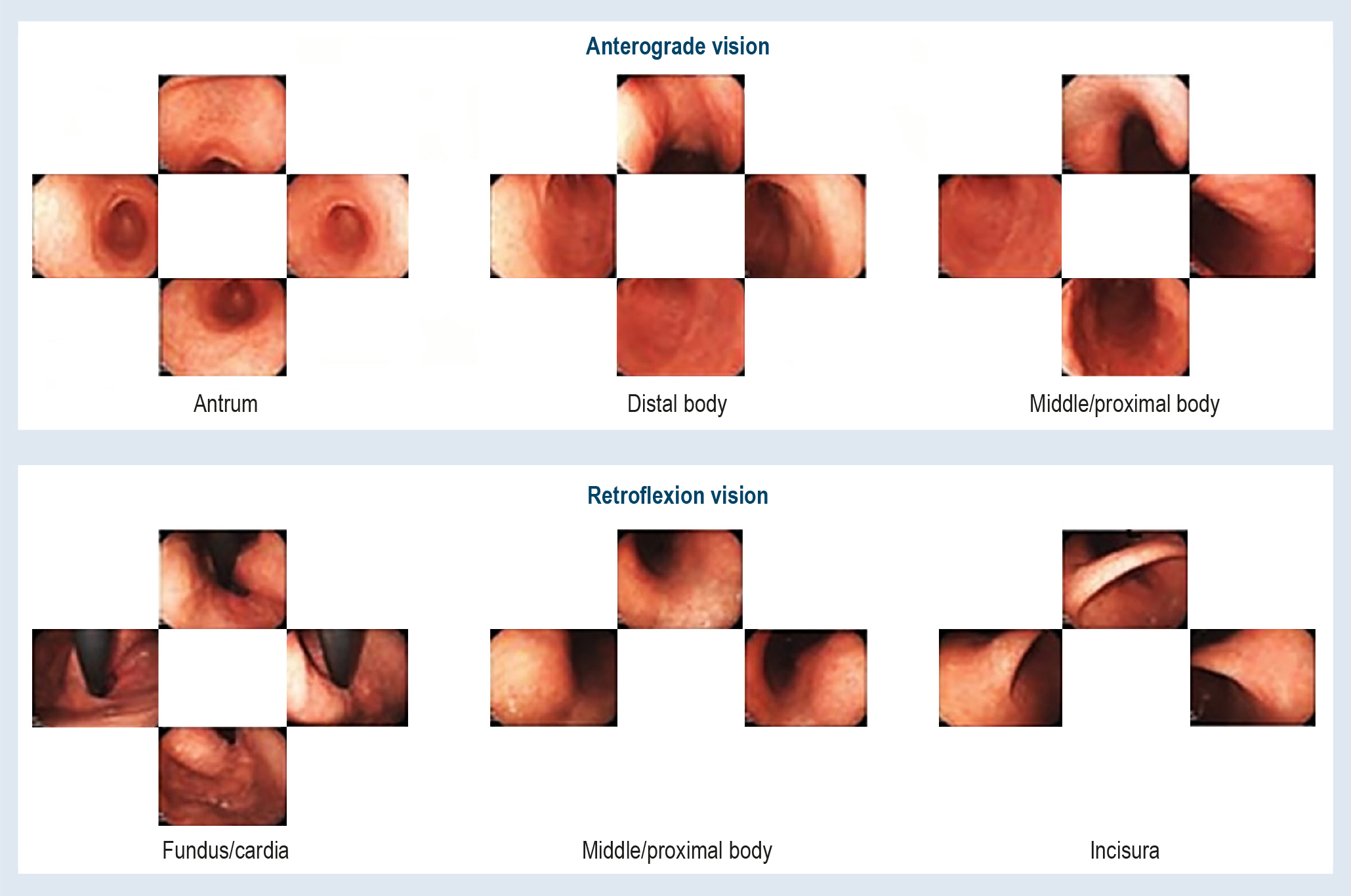 Figure 1. Systematic Screening Protocol for the Stomach (SSS). Adapted from: Toyoshima O, et al. World J Gastroenterol. 2020;26(5):466-77(38).