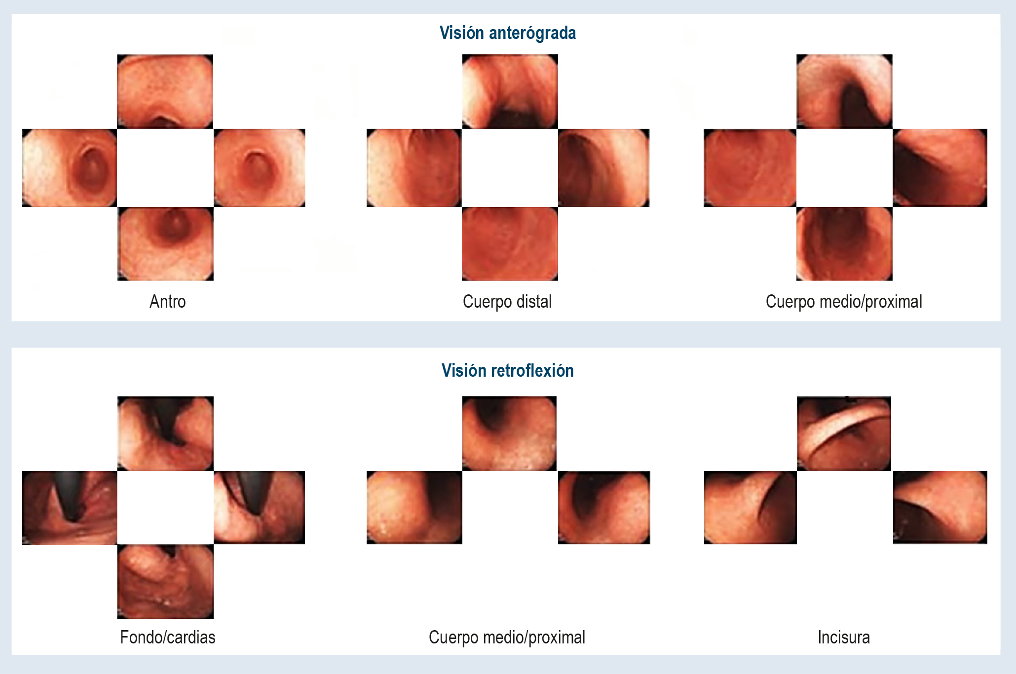 Figura 1. Protocolo de tamización sistemático para el estómago (SSS). Tomada de: Toyoshima O, et al. World J Gastroenterol. 2020;26(5):466-77(38)