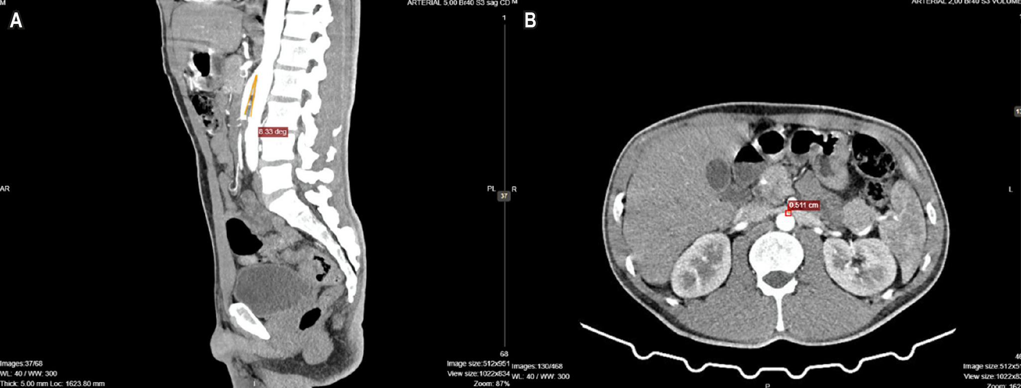 Figura 1. Tomografía de abdomen total doble contraste. A. Corte sagital, fase arterial. Se visualiza la pinza aortomesentérica con un ángulo de 8º. B. Corte transversa, fase arterial. Se visualiza la distancia aortomesentérica de 5 mm. Imágenes propiedad de los autores