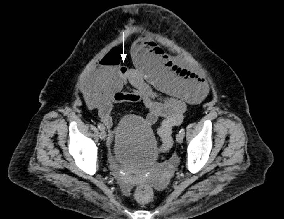 Figura 1. Obstrucción intestinal con zona de transición en el íleon distal. Tomografía simple de abdomen, con una flecha que señala la zona de transición, con estenosis en el íleon distal. Imagen propiedad de los autores.
