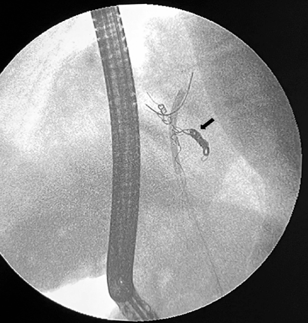 Figure 1. Fluoroscopic view, foreign bodies (coils) within the biliary tract (arrow). The image is the property of the authors.