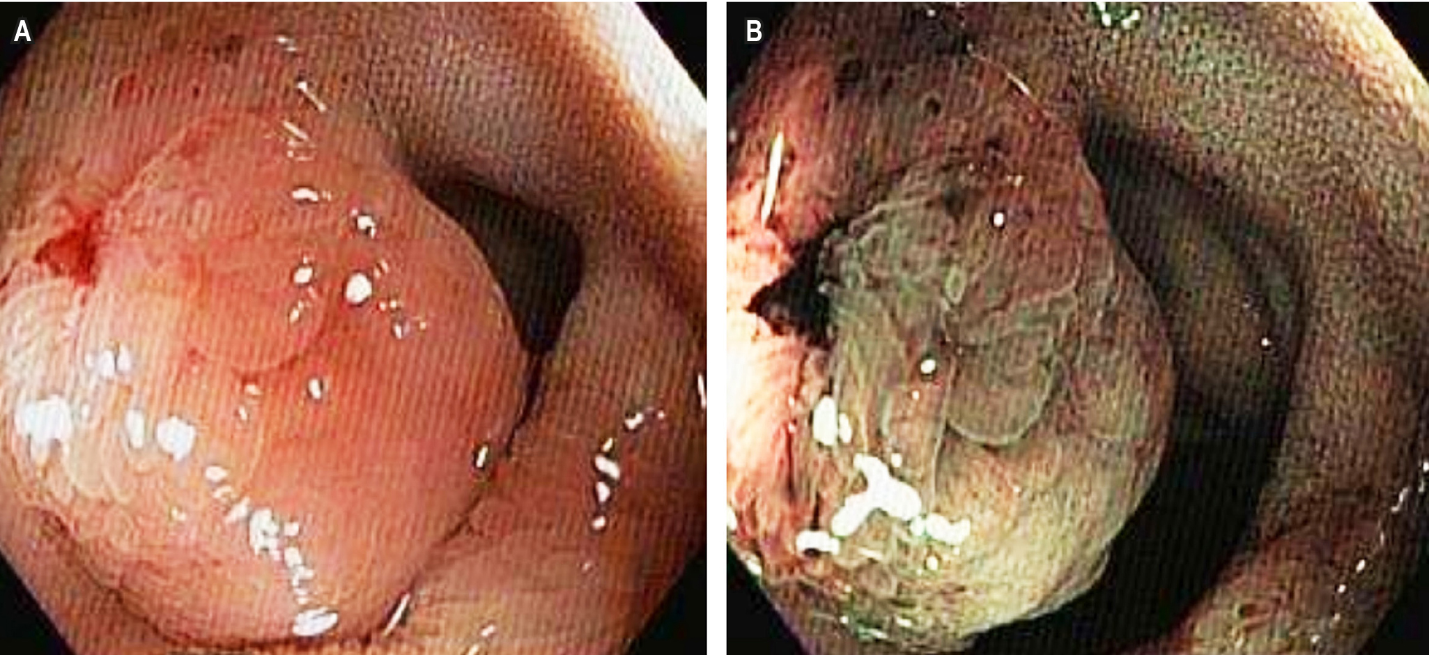 Figura 1. Ileocolonoscopia. Lesión polipoide sésil (clasificación de París: 0-Is) en el íleon distal. A. Imagen con luz blanca. B. Imagen con cromoendoscopia digital. Imágenes propiedad de los autores.