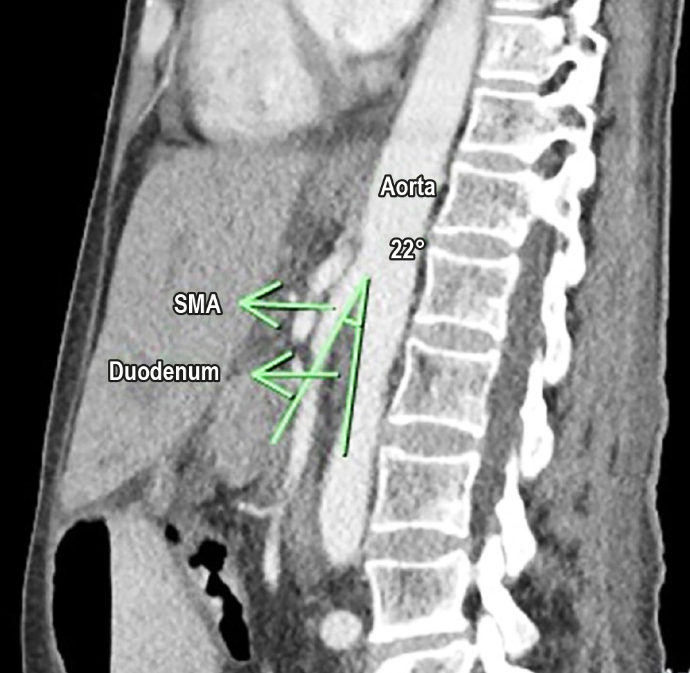 Figure 1. Contrast-enhanced abdominal CT scan in the sagittal section showing an angle of 22° between the aorta and the superior mesenteric artery. The image is the property of the authors.