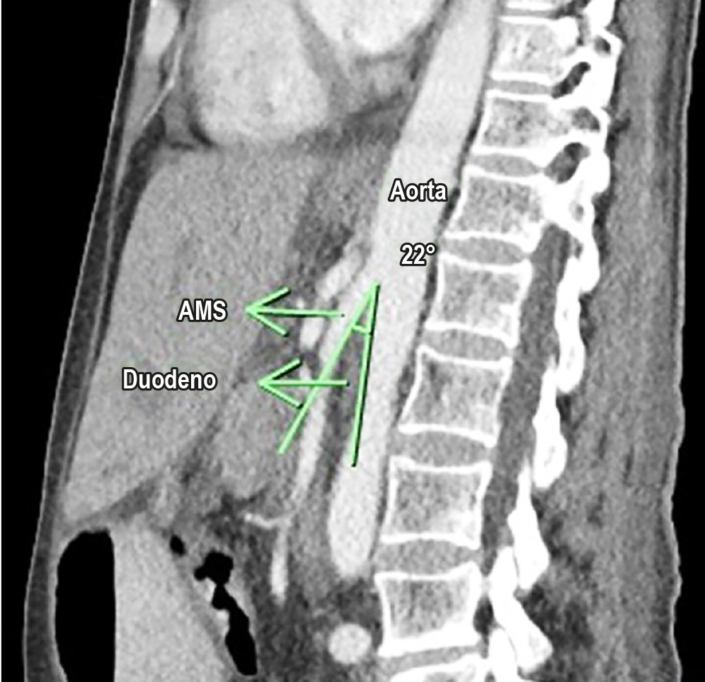 Figura 1. Tomografía de abdomen contrastada en corte sagital con ángulo entre la aorta y la arteria mesentérica superior de 22°. Imagen propiedad de los autores.