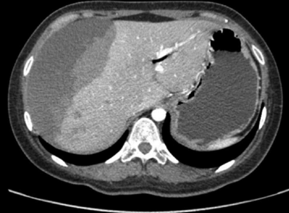 Figura 1. Hematoma hepático (206 x 81 x 160 mm) que compromete el lóbulo hepático derecho en el corte axial de la tomografía. Se evidencia contraste de densidades relacionado con hematoma con signos de sangrado activo. Imagen propiedad de los autores.