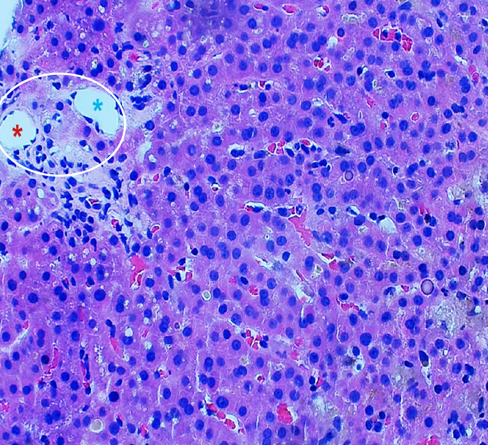 Figura 1. El corte histológico muestra parénquima hepático con espacio portal (círculo), donde se identifican vasos portales arteria y vena pero no se observa ducto biliar (* rojo: arteria, * azul: vena). Imagen propiedad de los autores.