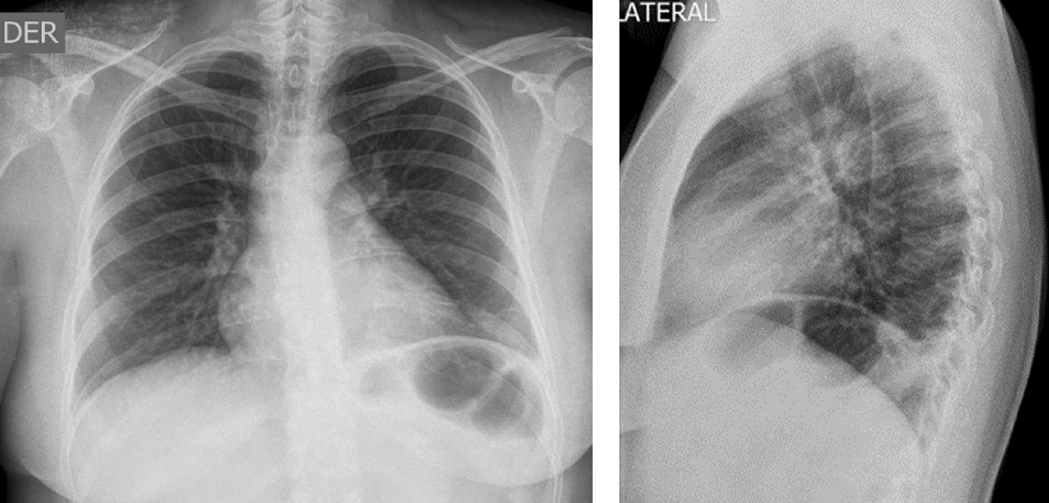 Figura 1. Radiografía de tórax. Signos sugestivos de infarto pulmonar (imagen en cuña retrocardíaca). Imágenes propiedad de los autores.