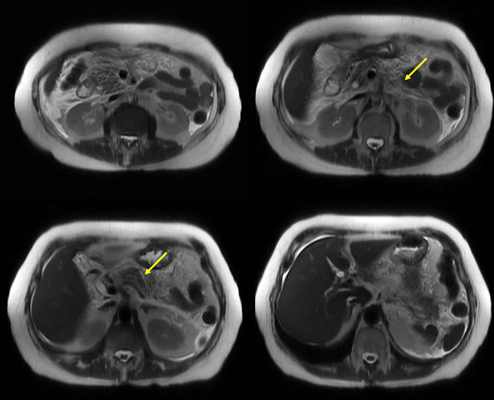 Figure 1. Abdominal MRCP: The pancreas shows a diffuse increase in size and signal intensity, with alteration of the adjacent fat. There is peripancreatic fluid extending bilaterally into the anterior pararenal spaces and along the paracolic gutters, as well as into the perihepatic and perisplenic regions. Images property of the authors.