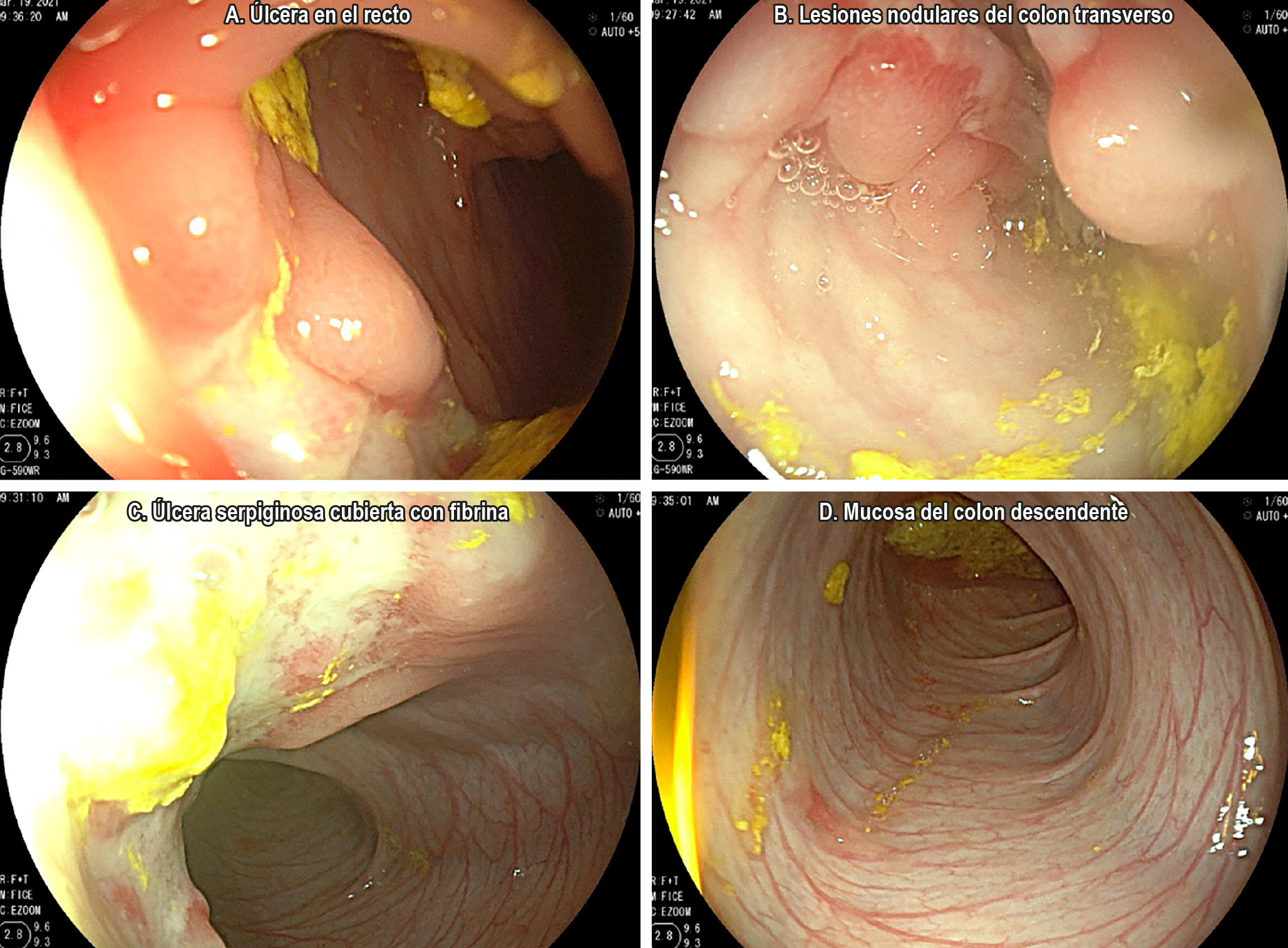 Figura 1. Colonoscopia inicial. A. Ano y región perianal sin lesiones, mala preparación. A 5 cm del margen anal se encuentra una gran úlcera rectal profunda recubierta por fibrina. B y C. Rectosigmoides con edema y nodularidad. En el colon transverso se evidencian múltiples lesiones nodulares ulceradas que conforman un conglomerado que produce estenosis parcial de la circunferencia del colon. D. El resto de la mucosa valorada hasta el ciego es de aspecto normal. No se logra canular la válvula ileocecal