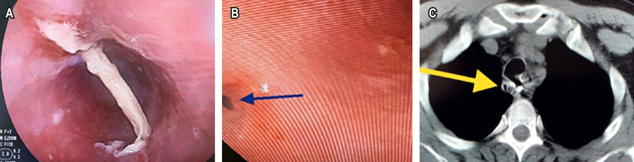 Figura 1. Cuerpo extraño ubicado en el esófago. A. Cuerpo extraño. B. Perforación en la pared esofágica. C. Tomografía con gas y medio de contraste contenido. Imágenes propiedad de los autores.