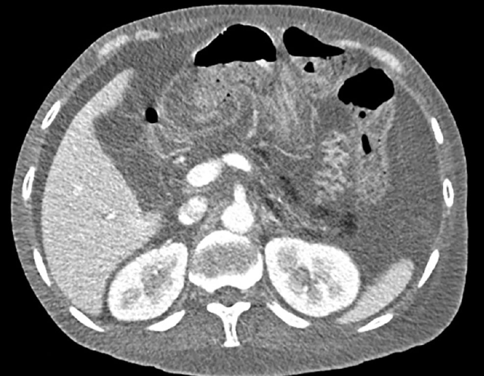 Figure 1. Axial CT scan showing atrophic pancreas with parenchymal microcalcifications suggestive of chronic pancreatitis. Image property of the authors.