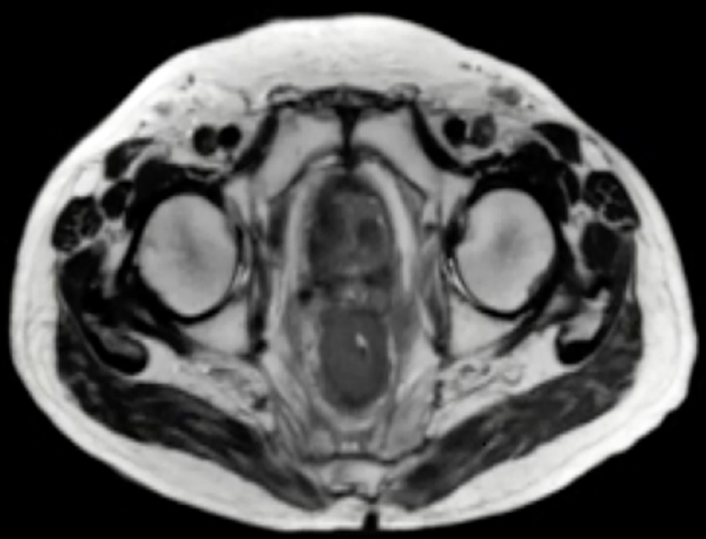 Figura 1. Resonancia magnética pélvica en T2 donde se evidencia un engrosamiento concéntrico de las paredes rectales. Imagen propiedad de los autores.