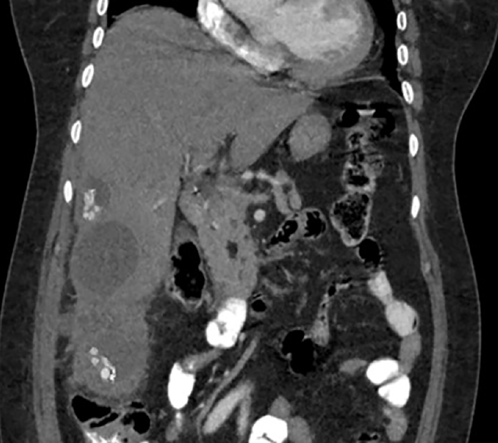 Figure 1. Coronal section of an abdominal CT scan showing hepatic and peritoneal involvement. Image property of the authors.