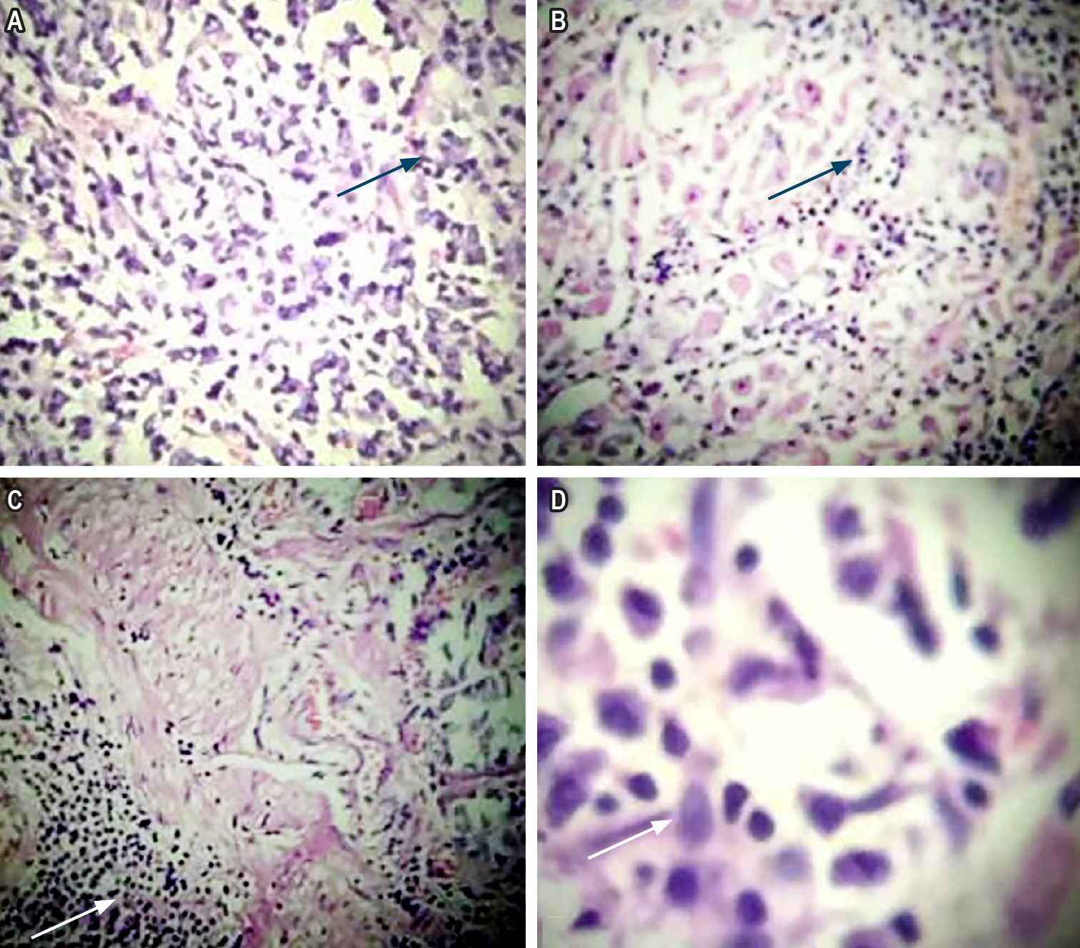 Figure 1. Gastrectomy specimen showing evidence of lymphoid infiltrate. Images property of the authors.