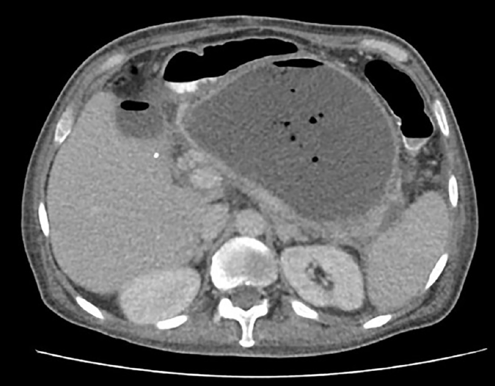 Figure 1. Initial CT scan showing pancreatic collection measuring 123 × 119 × 163 mm (L × AP × T). Image property of the authors.