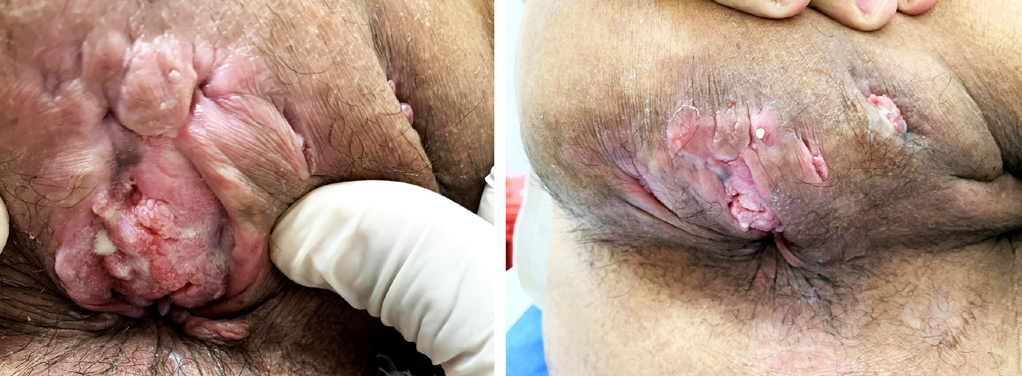 Figure 1. Macroscopic appearance of the inverted Buschke-Löwenstein tumor. Images property of Instituto de Coloproctología (ICO) S.A.S.
