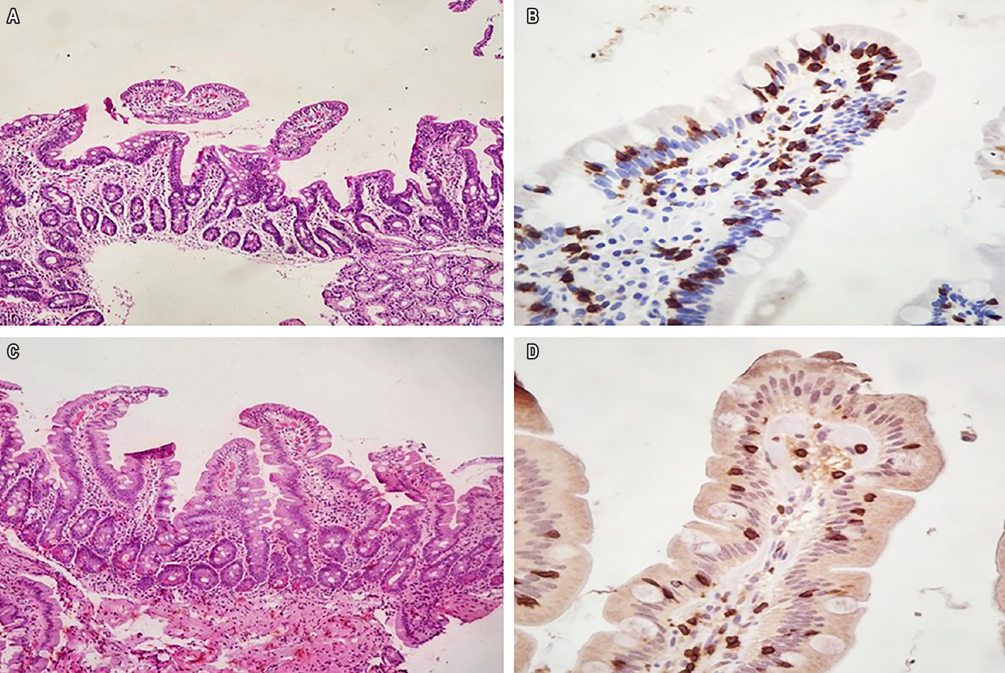 Figura 1. Histopatología de la mucosa duodenal. A. Biopsia duodenal antes del tratamiento; hematoxilina-eosina que muestra Marsh 3-A (100X). B. Inmunohistoquímica antes del tratamiento que muestra una alta cantidad de IEL: CD8 >50% de los IEL, compatible con ECR tipo 1 (400X). C. Biopsia duodenal después del tratamiento; hematoxilina-eosina que muestra Marsh 0 (100X). D. Inmunohistoquímica después del tratamiento que muestra un recuento de CD8 normal (400X). Imágenes propiedad de los autores.