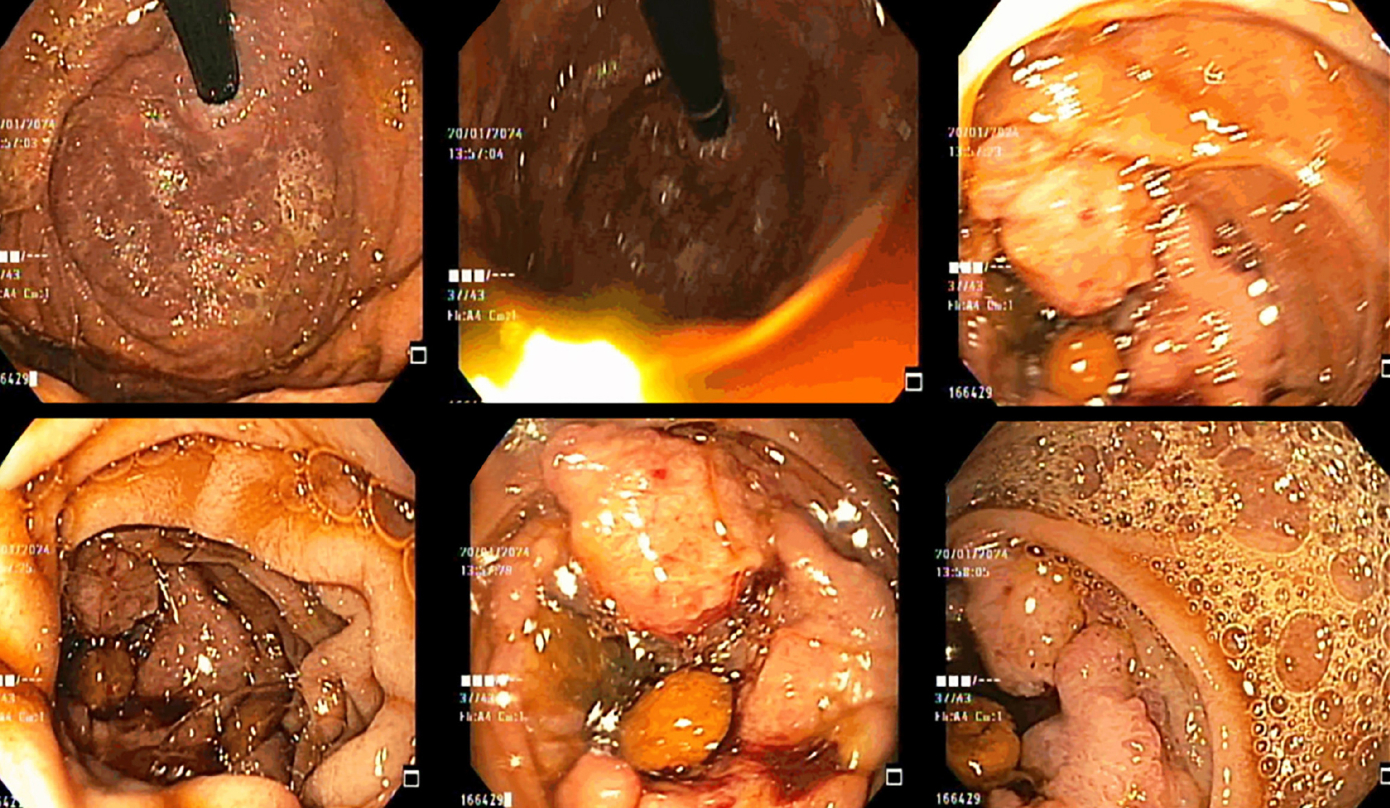 Figura 1. Esofagogastroduodenoscopia extrainstitucional con lesión polipoide ulcerada. Tomada de: Servicio de Gastroenterología, Centro de especialistas. Seleccionada por los autores.