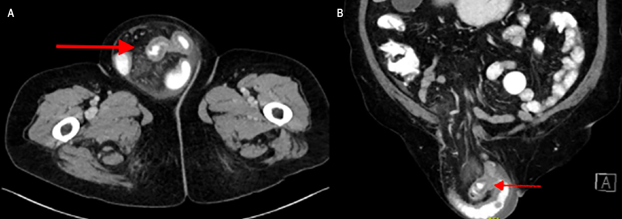 Figura 1. Tomografía axial computarizada de abdomen. A. Corte axial. B. Corte coronal. Defecto herniario señalado con línea roja. Imágenes propiedad de los autores