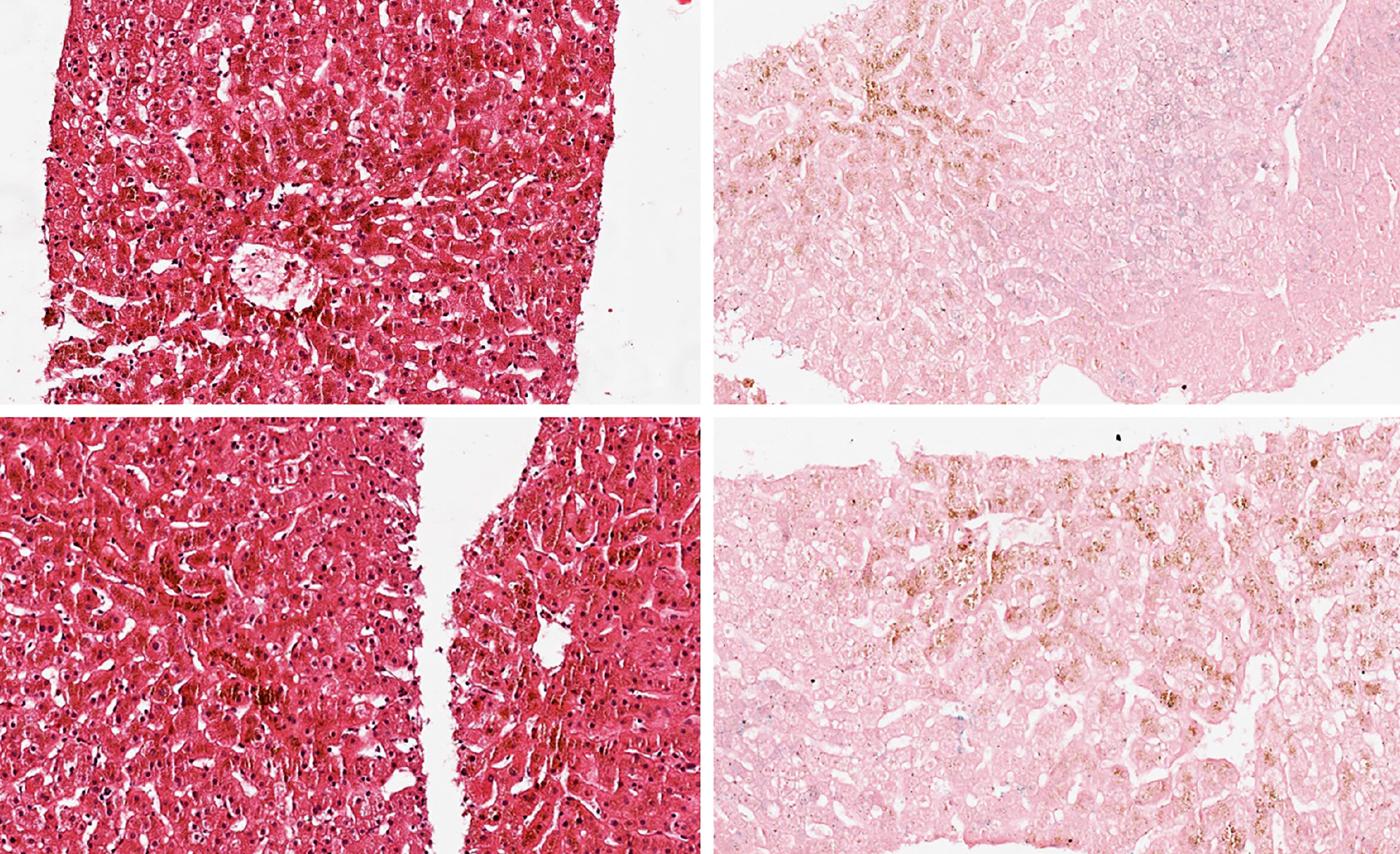 Figura 1. Biopsia hepática del paciente con síndrome de Dubin-Johnson. Imágenes propiedad de los autores