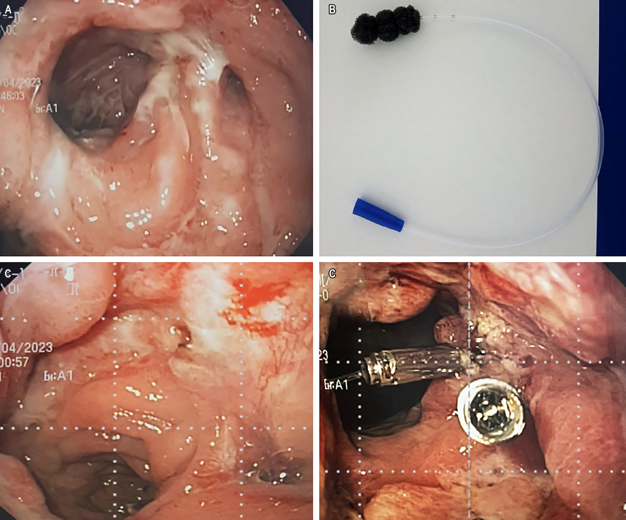 Figura 1. Imágenes endoscópicas del caso clínico. A. Visualización endoscópica de la fístula colorrectal. B. Instrumento con Tecnica Endo-Vac modificada realizado con una sonda nasogástrica de 12 Fr, con un fragmento de esponja en su extremo, fija con una sutura transfixiante, a una presión de -80 mmHg. C. Seguimiento endoscópico después de una semana de manejo con el sistema Endo-Vac modificado. D. Visualización de clips hemostáticos posteriores al uso del sistema Endo-Vac modificado. Imágenes propiedad de los autores.