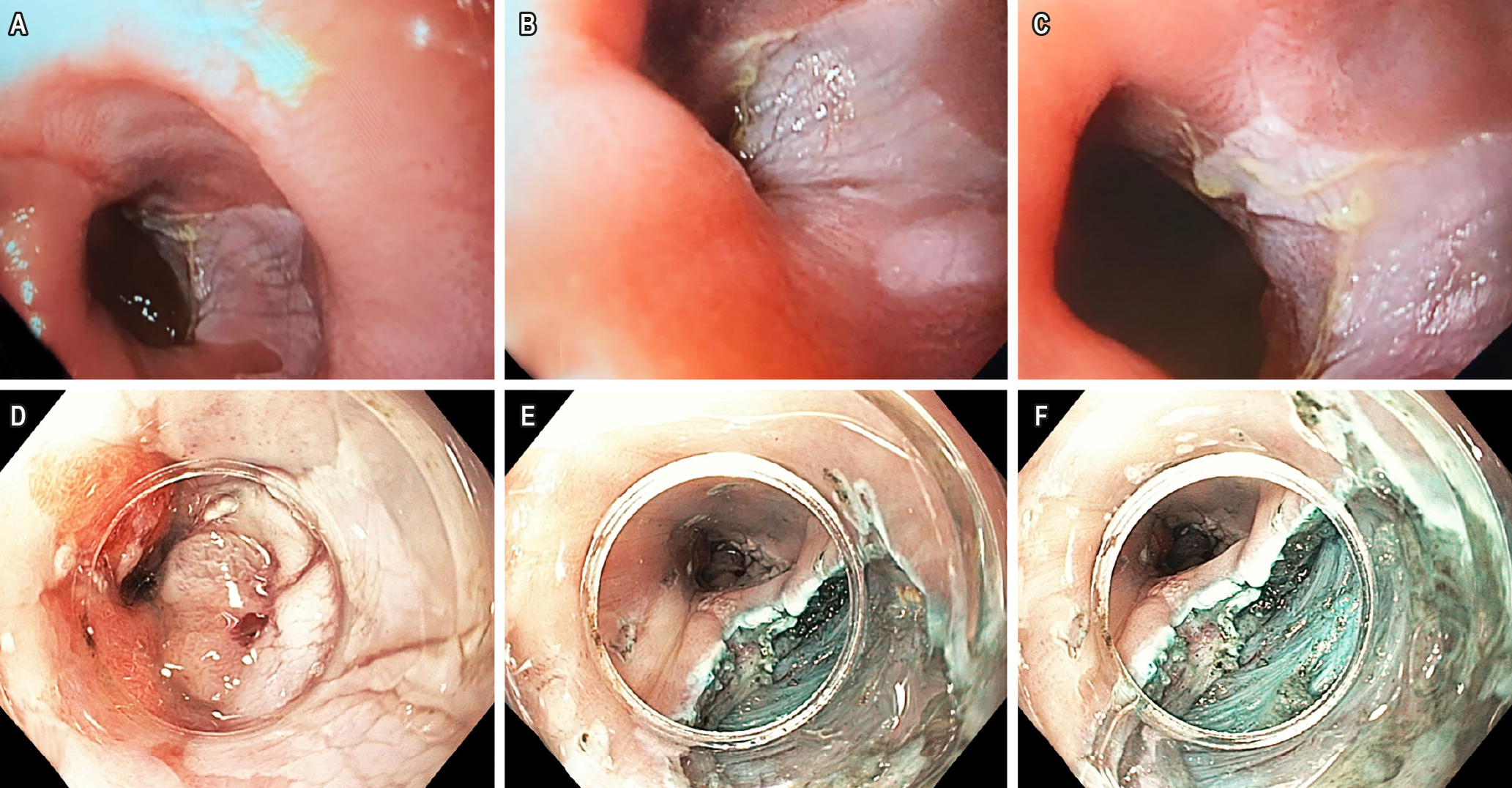 Figura 1. Exámenes del caso clínico. A, B y C. EGD que muestra una lesión de 30 mm en el esófago distal caracterizada como placa blanquecina bien delimitada con mucosa circundante normal y sugestiva de leucoplasia. D. Leucoplasia elevada con ácido hialurónico, solución salina y azul de metileno antes de la disección vista a través de Cap. E y F. Disección submucosa endoscópica de leucoplasia esofágica. Lecho de resección. Imágenes propiedad de los autores.