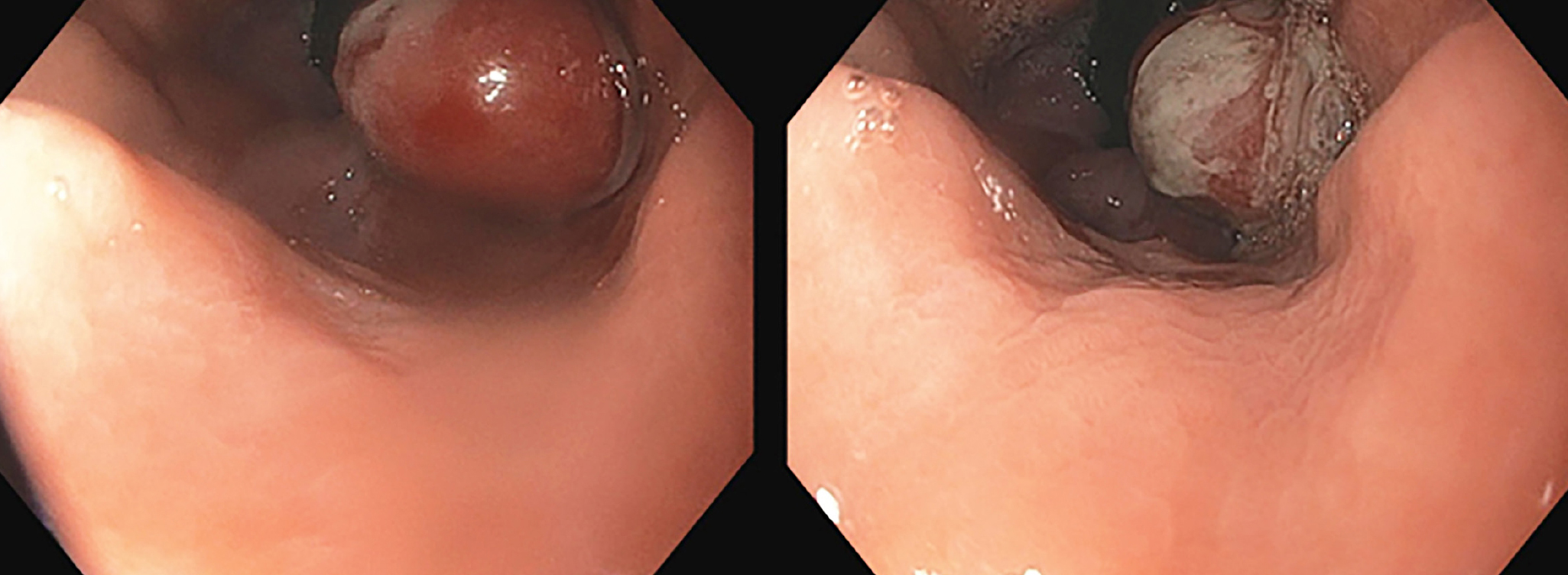 Figura 1. Pólipo localizado a 38 cm de las arcadas dentarias, en vecindad con la línea Z. Imágenes propiedad de los autores