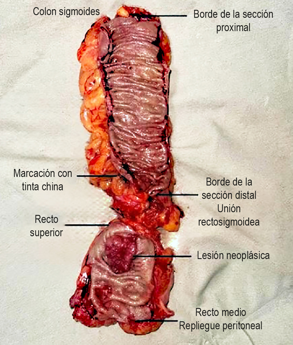 Figura 1. Falta de precisión en la localización del tumor en el colon que deriva en una nueva resección laparoscópica del colon. Imagen propiedad de los autores.