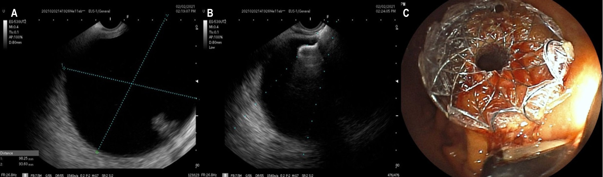 Figure 1. Technical aspects in LAMS placement. A. Ultrasonographic appearance of pancreatic pseudocyst. B. Release of the distal end of the LAMS. C. Endoscopic appearance of the released stent. Image owned by the authors.