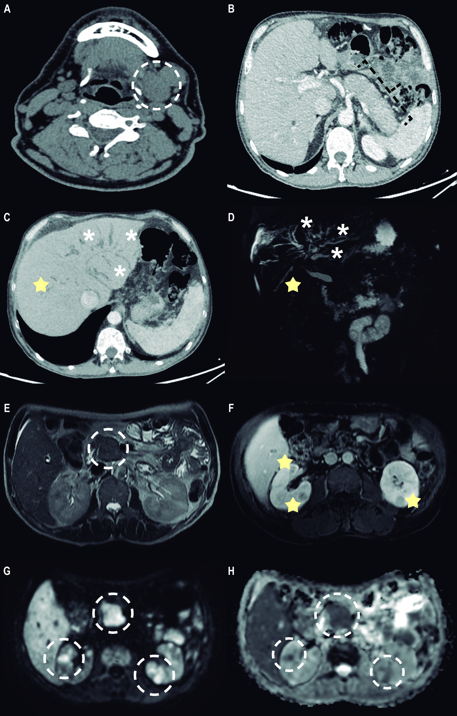 Figura 1. A. La tomografía axial computarizada (TAC) sin contraste 2 años antes de la admisión muestra un aumento de volumen de la glándula submandibular izquierda, asociado con algunas adenopatías adyacentes. B. La TAC con contraste muestra un halo hipoatenuante característico alrededor del cuerpo y la cola del páncreas, un hallazgo sugestivo de pancreatitis autoinmune difusa. C y D. La reconstrucción MinIP y la colangiorresonancia muestran una dilatación de la vía biliar intrahepática (asterisco), así como áreas de estenosis segmentarias (estrella). E. Imagen de resonancia magnética axial ponderada en T2 que muestra un agrandamiento focal bien delimitado a nivel de la cabeza, que se correlaciona con restricción en la difusión (G). F, G y H. Imagen de resonancia magnética axial ponderada en T1 con contraste que muestra múltiples lesiones nodulares renales bien definidas, las cuales muestran realce a la administración de contraste y se correlacionan con restricción a la difusión (G y H). Fuente: expediente médico del paciente