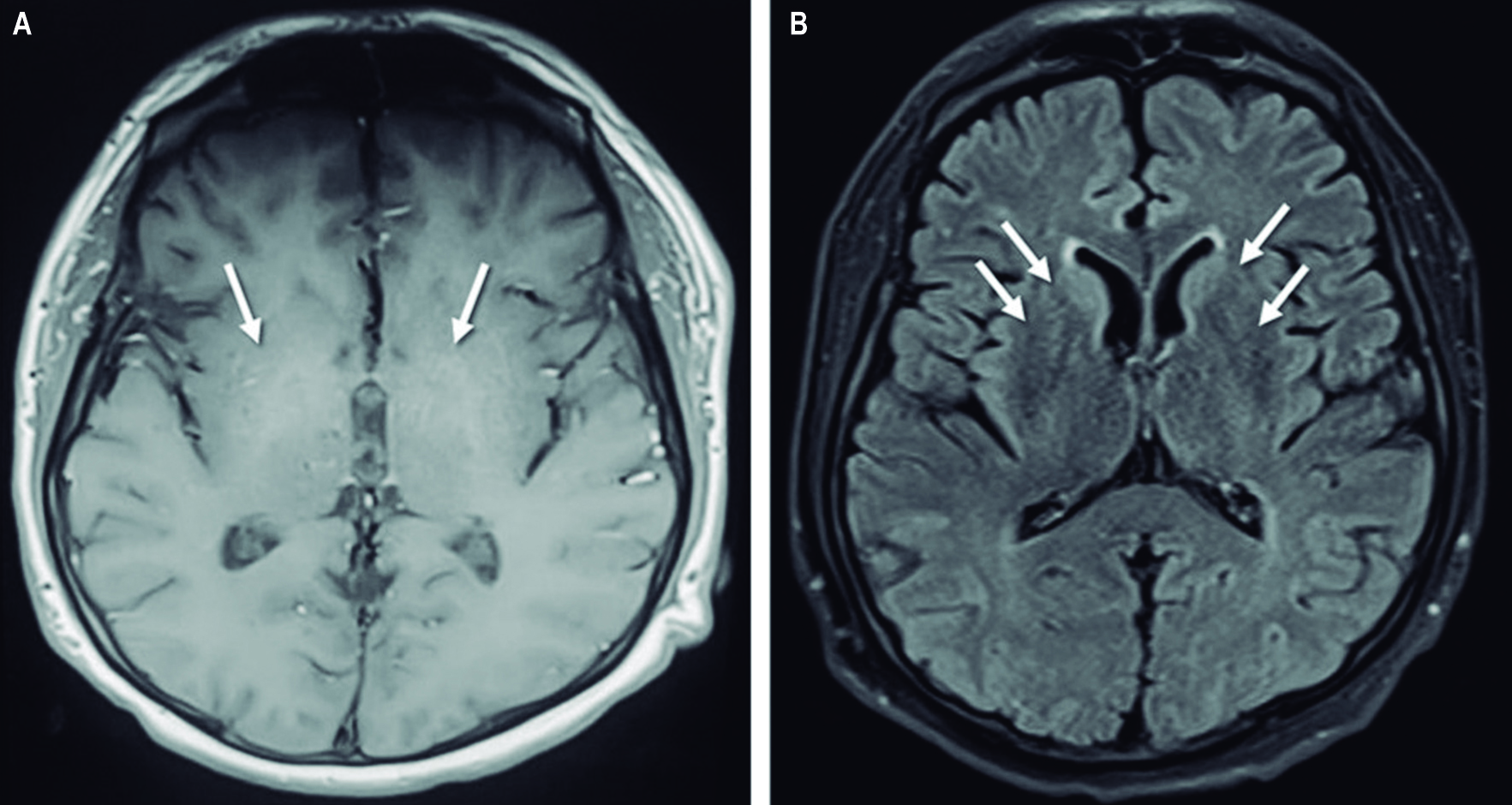 Figura 1. Resonancia magnética nuclear cerebral secuencias T1 (A) FLAIR (B). Las flechas muestran áreas de hiperintensidad en los núcleos basales bilaterales. Fuente: archivo de los autores.