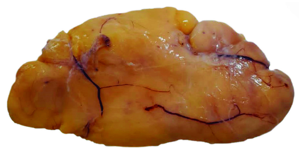 Figura 1. Lipoma expulsado por vía rectal con paredes bien definidas y sin datos de sangrado. Fuente: archivo de los autores.